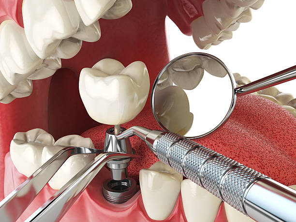 Best Urgent Care for Lost Fillings or Crowns in Honea Path, SC